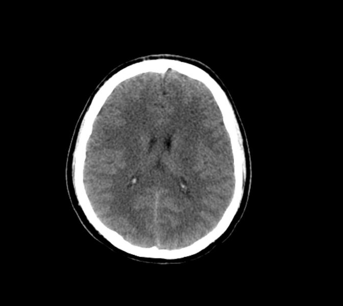 File:Cerebral fat embolism (Radiopaedia 37510-39362 Axial non-contrast 21).jpg