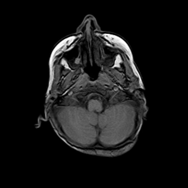 File:Cerebral tuberculoma (Radiopaedia 41152-43932 Axial T1 3).jpg