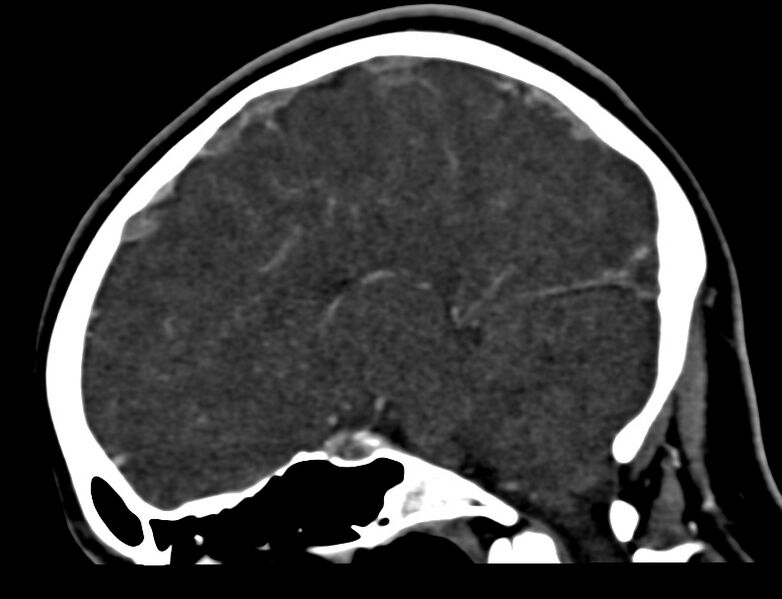 File:Cerebral venous sinus thrombosis (Radiopaedia 59224-66646 Sagittal C+ delayed 30).jpg