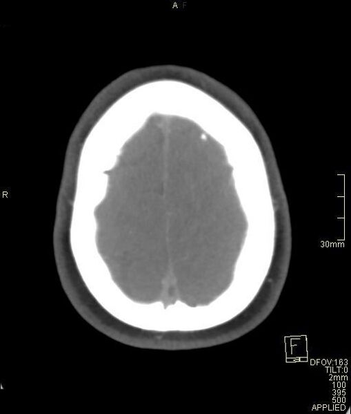 File:Cerebral venous sinus thrombosis (Radiopaedia 91329-108965 Axial venogram 70).jpg
