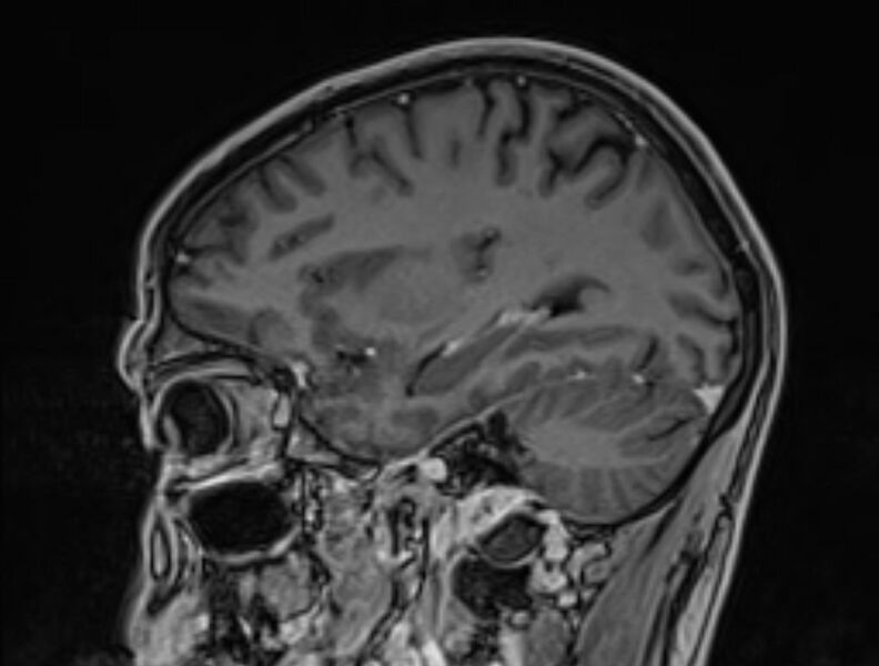 File:Cerebral venous thrombosis (Radiopaedia 71207-81504 Sagittal T1 C+ 17).jpg