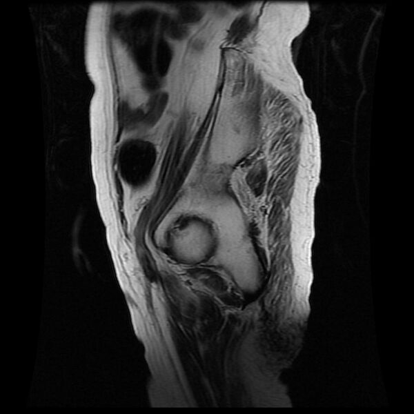 File:Cervical carcinoma (Radiopaedia 78847-91705 Sagittal T2 16).jpg
