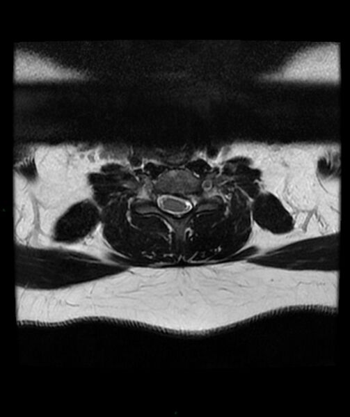 File:Cervical disc prolapse (Radiopaedia 80258-93598 Axial T2 50).jpg