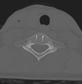 Cervical disc replacement (Radiopaedia 37383-39205 Axial bone window 13).png