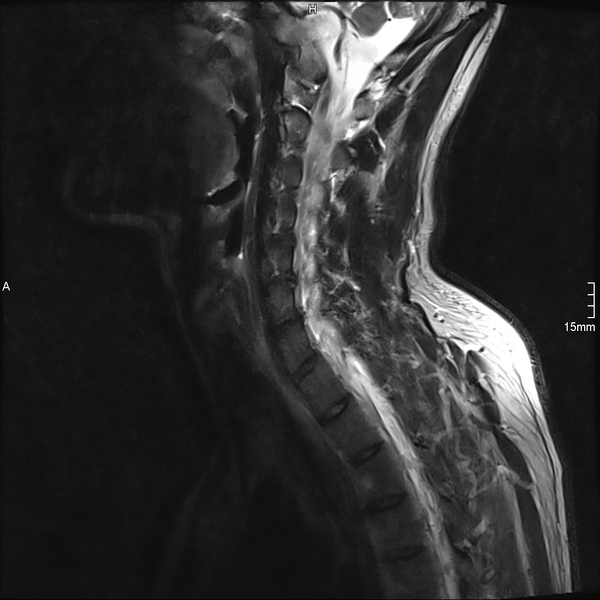 File:Cervical dural CSF leak on MRI and CT treated by blood patch (Radiopaedia 49748-54995 Sagittal T2 9).png