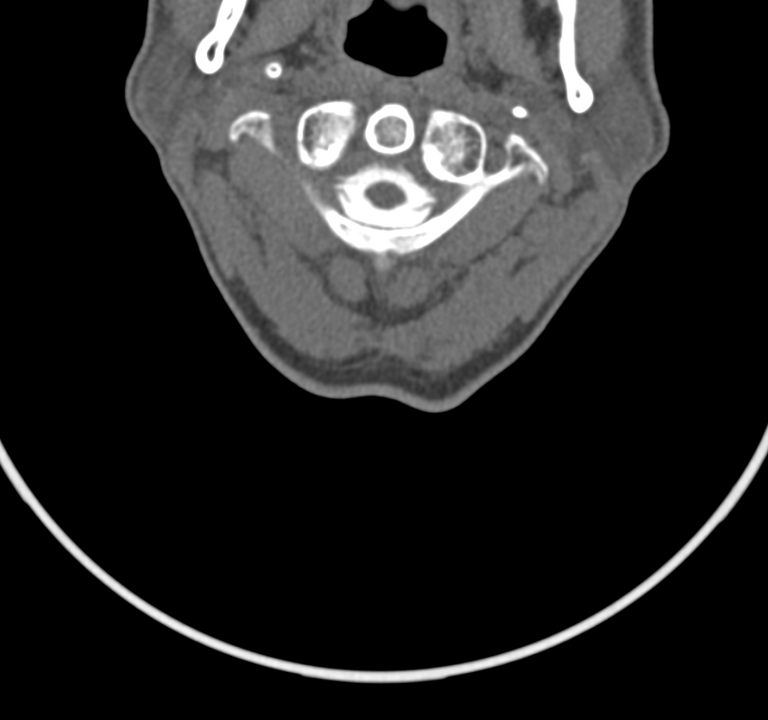 Cervical dural CSF leak on MRI and CT treated by blood patch (Radiopaedia 49748-54996 B 14).png