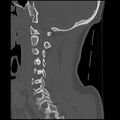 Cervical flexion teardrop fracture with cord hemorrhage (Radiopaedia 32497-33454 Sagittal bone window 16).jpg