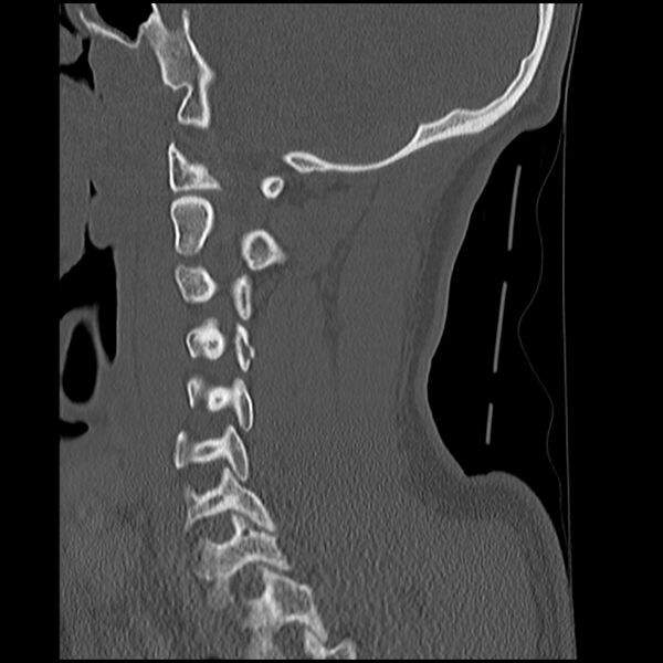 File:Cervical flexion teardrop fracture with cord hemorrhage (Radiopaedia 32497-33454 Sagittal bone window 16).jpg