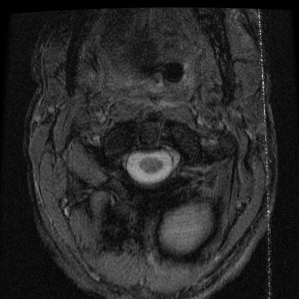 File:Cervical flexion teardrop fracture with cord hemorrhage (Radiopaedia 32497-33455 Axial Gradient Echo 1).jpg