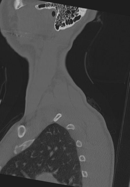 File:Cervical intercalary bone (Radiopaedia 35211-36748 Sagittal bone window 2).png