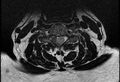 Cervical schwannoma (Radiopaedia 72399-82934 Axial T2 12).jpg