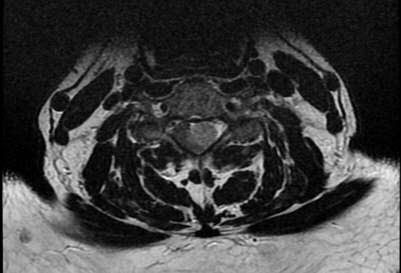 File:Cervical schwannoma (Radiopaedia 72399-82934 Axial T2 12).jpg