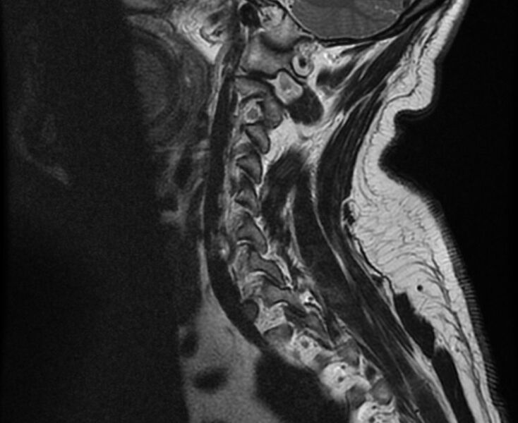 File:Cervical schwannoma (Radiopaedia 72399-82934 Sagittal T2 4).jpg