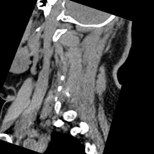 File:Cervical spinal neurofibroma in a patient with NF1 (Radiopaedia 58344-65464 C 43).jpg