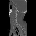 Cervical spine fractures with vertebral artery dissection (Radiopaedia 32135-33078 Sagittal bone window 12).jpg