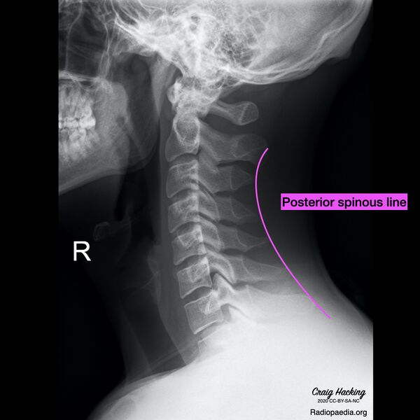 File:Cervical spine lines (Radiopaedia 76069-87571 J 1).jpeg