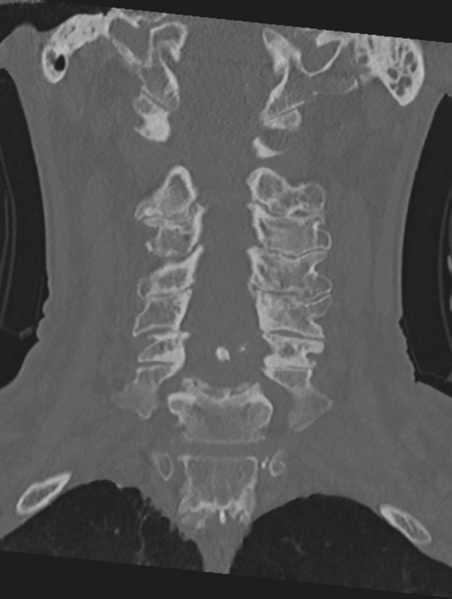 File:Cervical spondylolysis (Radiopaedia 49616-54811 Coronal bone window 25).png