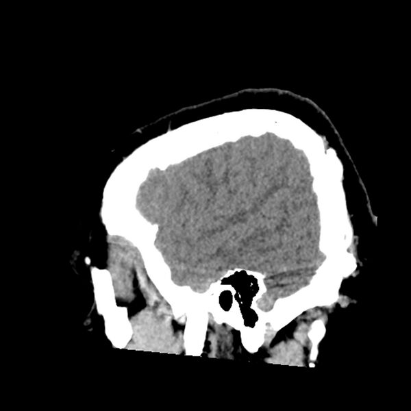File:Chiasmatic-hypothalamic juvenile pilocytic astrocytoma (Radiopaedia 78533-91237 B 51).jpg