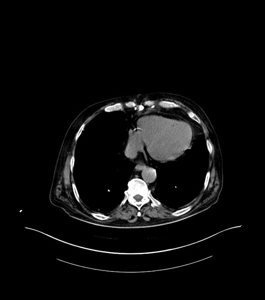 File:Cholangiocarcinoma with cerebral metastases (Radiopaedia 83519-98629 Axial non-contrast 1).jpg