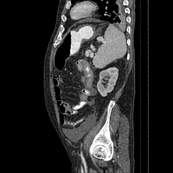 File:Cholangitis and abscess formation in a patient with cholangiocarcinoma (Radiopaedia 21194-21100 B 4).jpg