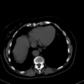 Cholecystitis - CT IVC obstructive choledocholitiasis (Radiopaedia 43966-47479 C 10).png