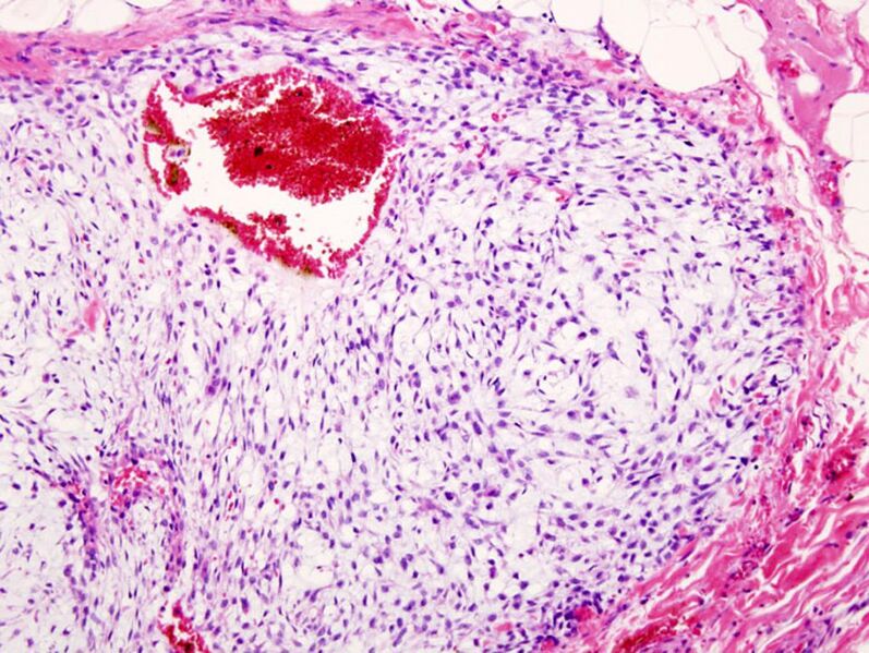 File:Chondrosarcoma (histology) (Radiopaedia 36352-37907 H&E 1).jpg