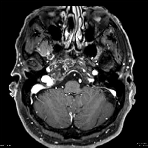 File:Chondrosarcoma of skull base- grade II (Radiopaedia 40948-43654 Axial T1 C+ 9).jpg