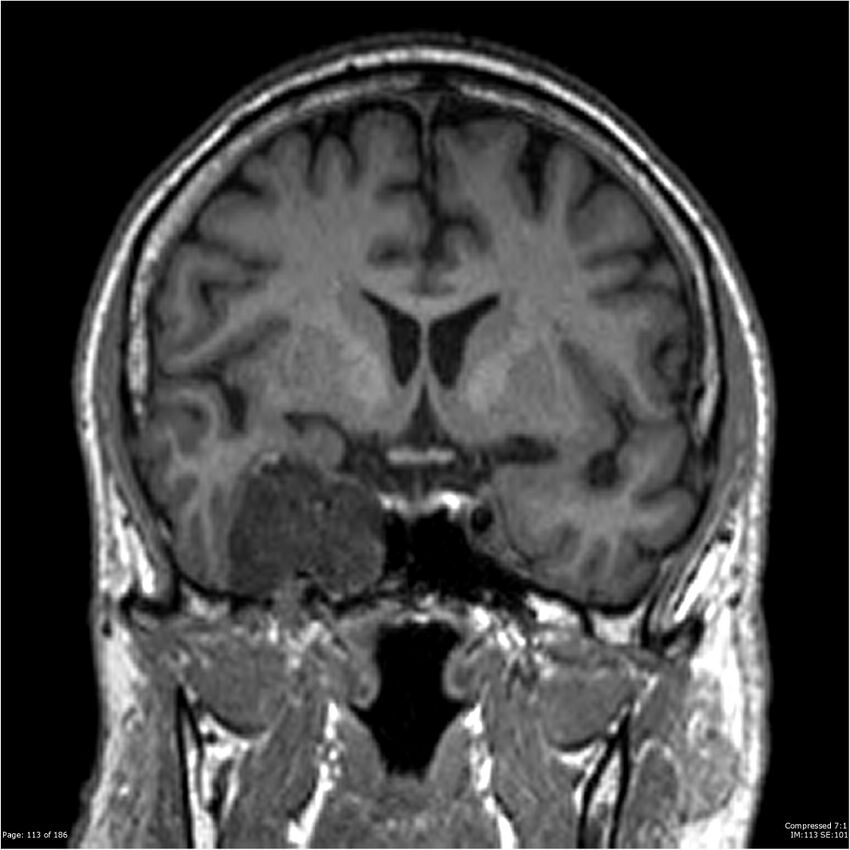 Chondrosarcoma of skull base- grade II (Radiopaedia 40948-43654 Coronal T1 34).jpg