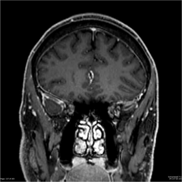File:Chondrosarcoma of skull base- grade II (Radiopaedia 40948-43654 Coronal T1 C+ 48).jpg