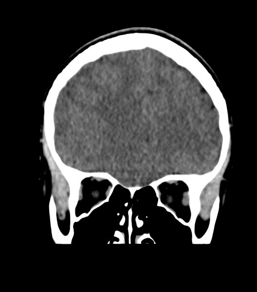 File:Choroid plexus carcinoma (Radiopaedia 91013-108552 Coronal non-contrast 23).jpg