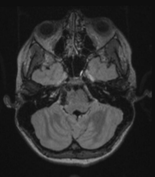 File:Choroid plexus carcinoma (Radiopaedia 91013-108553 Axial FLAIR C+ 91).jpg