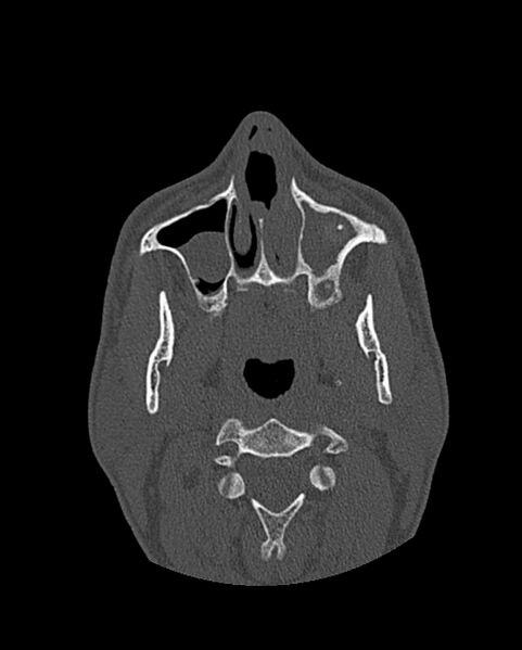 File:Chronic maxillary sinusitis caused by a foreign body (Radiopaedia 58521-65676 Axial bone window 82).jpg
