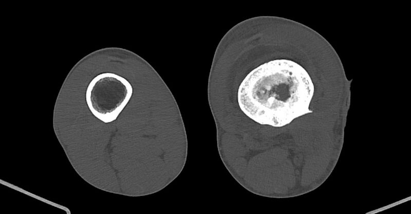 File:Chronic osteomyelitis (with sequestrum) (Radiopaedia 74813-85822 Axial non-contrast 150).jpg