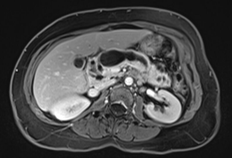File:Chronic pancreatitis - pancreatic duct calculi (Radiopaedia 71818-82250 Axial T1 C+ fat sat 31).jpg