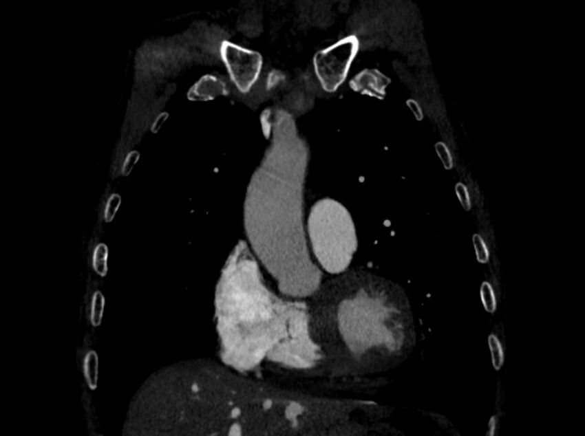 Chronic pulmonary embolism (Radiopaedia 91241-108843 A 26).jpg