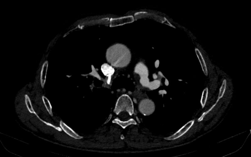 File:Chronic pulmonary embolism (Radiopaedia 91241-108843 B 74).jpg