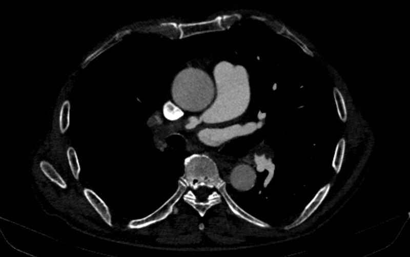 File:Chronic pulmonary embolism (Radiopaedia 91241-108843 B 93).jpg