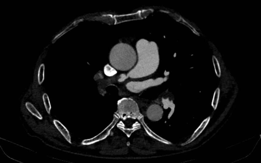 Chronic pulmonary embolism (Radiopaedia 91241-108843 B 93).jpg