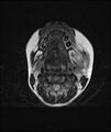 Chronic reactive multifocal osteomyelitis (CRMO) - mandible (Radiopaedia 56405-63069 Axial T2 9).jpg