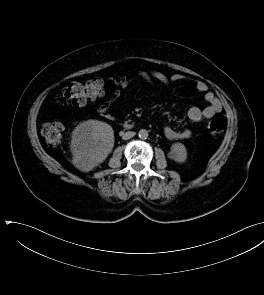 File:Clear cell renal cell carcinoma (Radiopaedia 85004-100537 Axial non-contrast 20).jpg