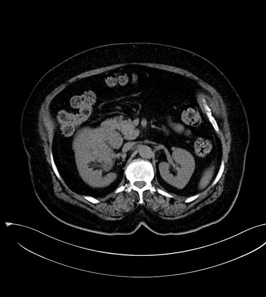 File:Clear cell renal cell carcinoma (Radiopaedia 85004-100537 Axial non-contrast 8).jpg