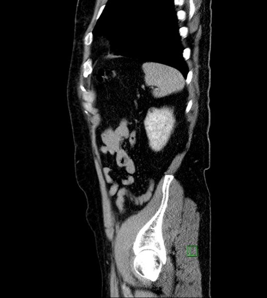 File:Clear cell renal cell carcinoma (Radiopaedia 85006-100539 G 12).jpg