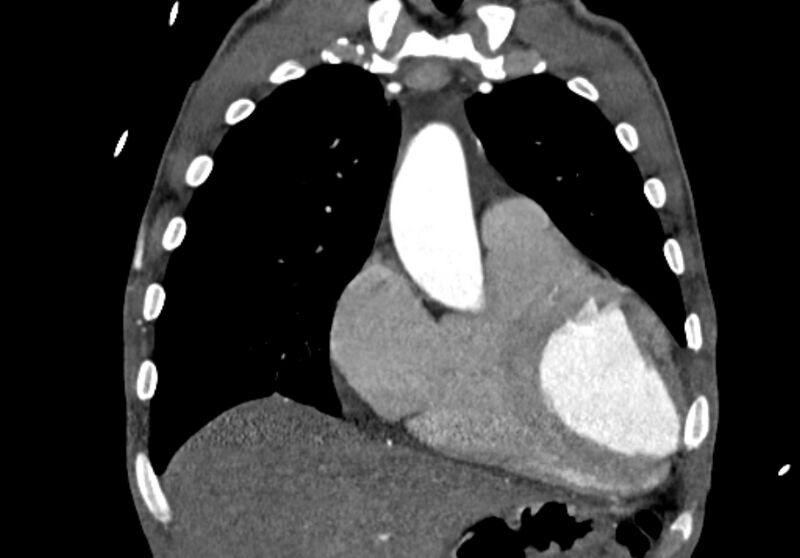 File:Coarctation of aorta with aortic valve stenosis (Radiopaedia 70463-80574 C 53).jpg