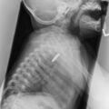 Coin in esophagus (Radiopaedia 7905-8747 Lateral 1).jpg