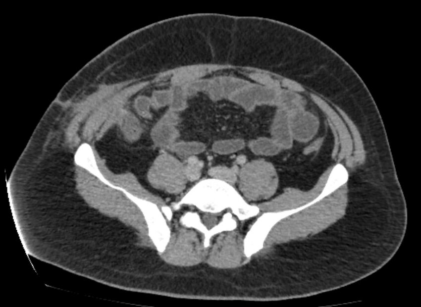 Colocutaneous fistula (Radiopaedia 56401-63062 A 64).jpg