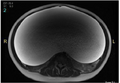 MRI giant serous cystadenoma ovary