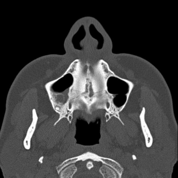 File:Nasal septal perforation (Radiopaedia 25030-25289 Axial bone window 4).jpg