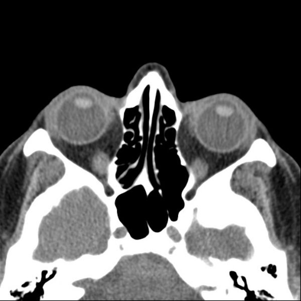 File:Nasolabial cyst (Radiopaedia 33987-35205 Axial non-contrast 31).jpg