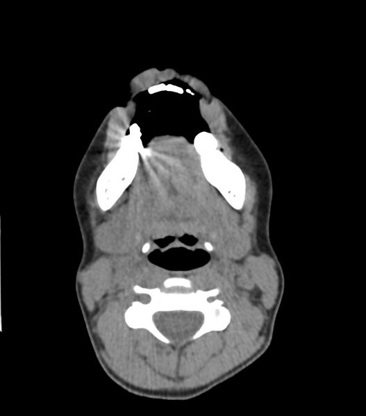 File:Nasoorbitoethmoid fracture (Radiopaedia 90044-107205 Axial non-contrast 59).jpg