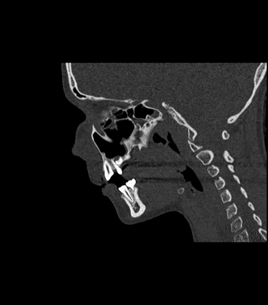 File:Nasoorbitoethmoid fracture (Radiopaedia 90044-107205 Sagittal bone window 62).jpg